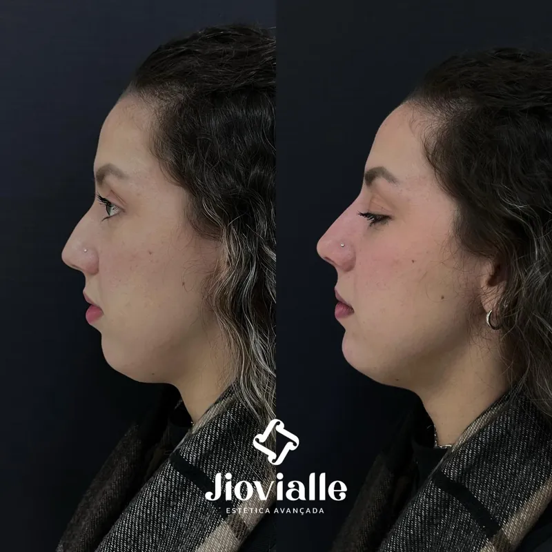 Post do Instagram da Jiovialle Estética Avançada