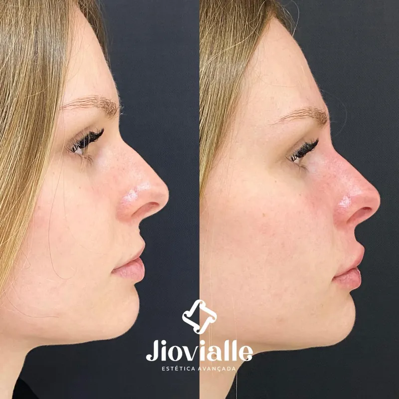 Post do Instagram da Jiovialle Estética Avançada