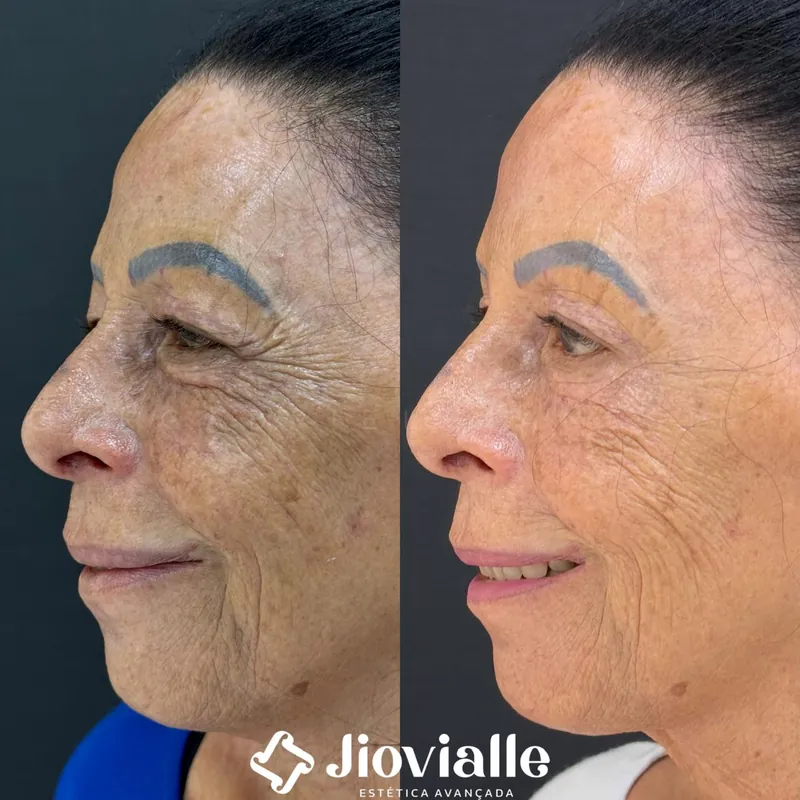 Post do Instagram da Jiovialle Estética Avançada