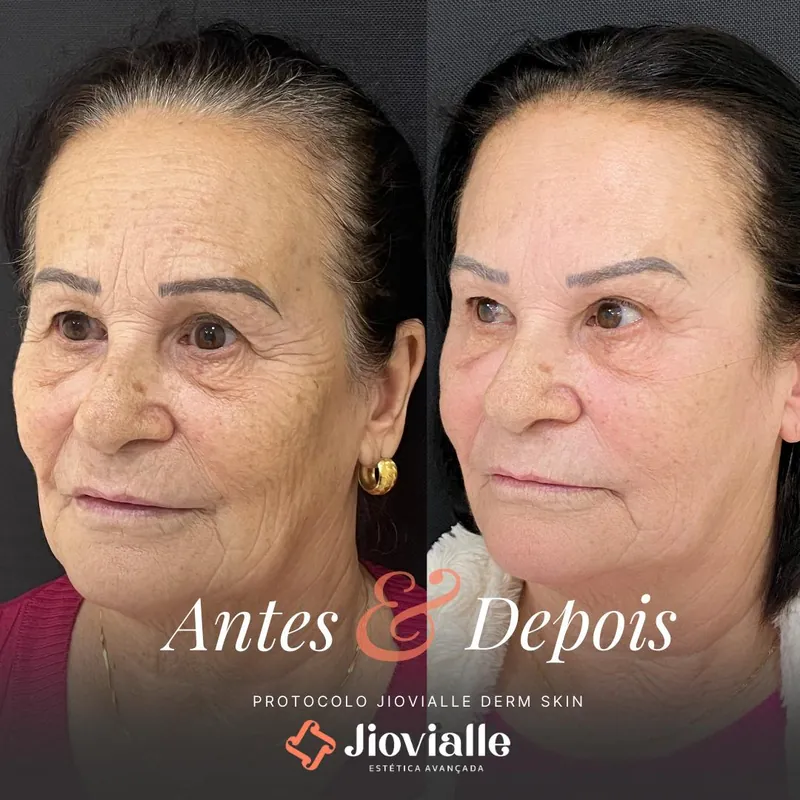 Post do Instagram da Jiovialle Estética Avançada