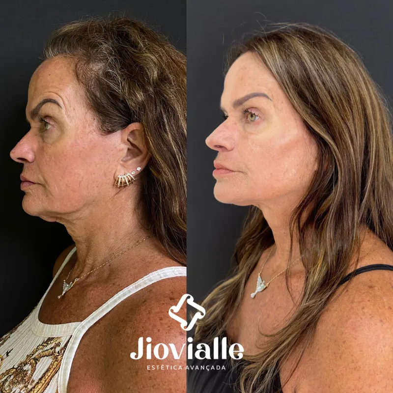 Post do Instagram da Jiovialle Estética Avançada