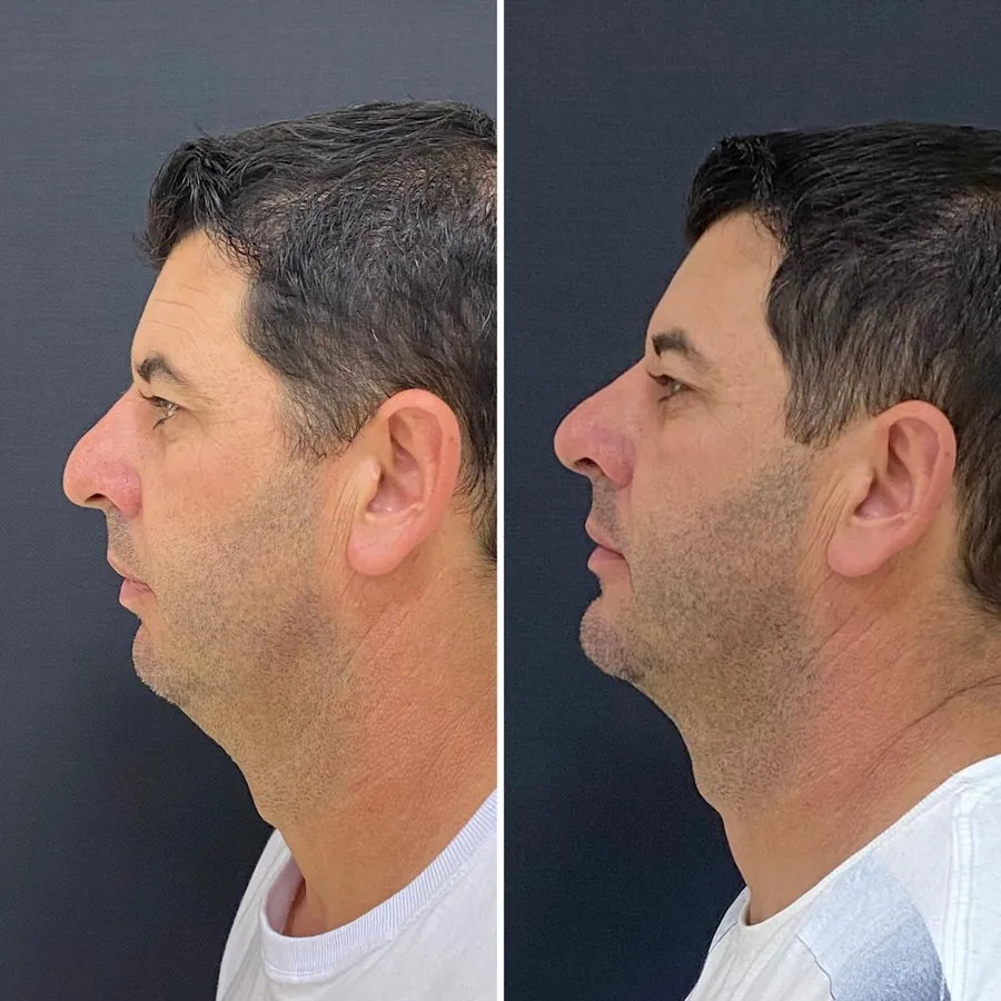 Antes e depois de paciente atendido na Jiovialle Estética Avançada