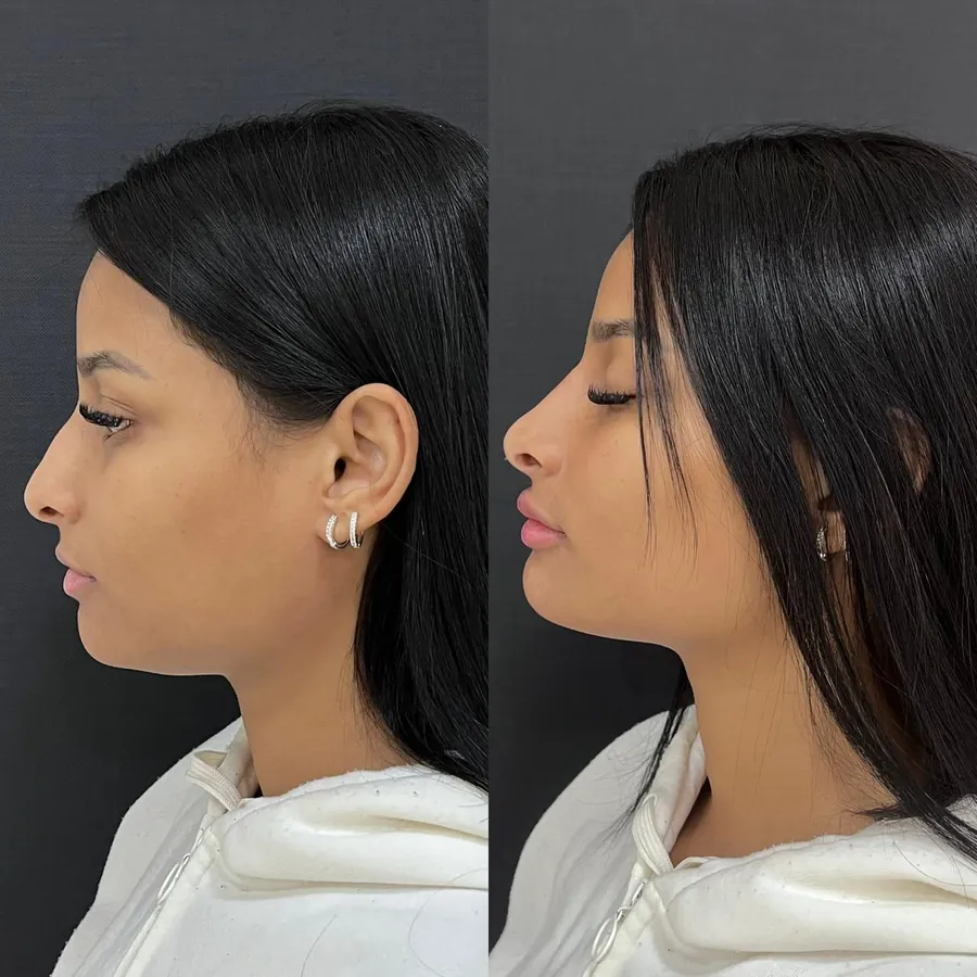 Antes e depois de paciente atendido na Jiovialle Estética Avançada