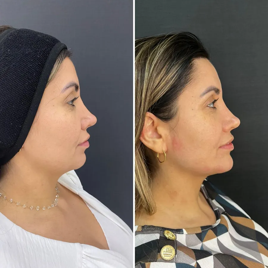 Antes e depois de paciente atendido na Jiovialle Estética Avançada