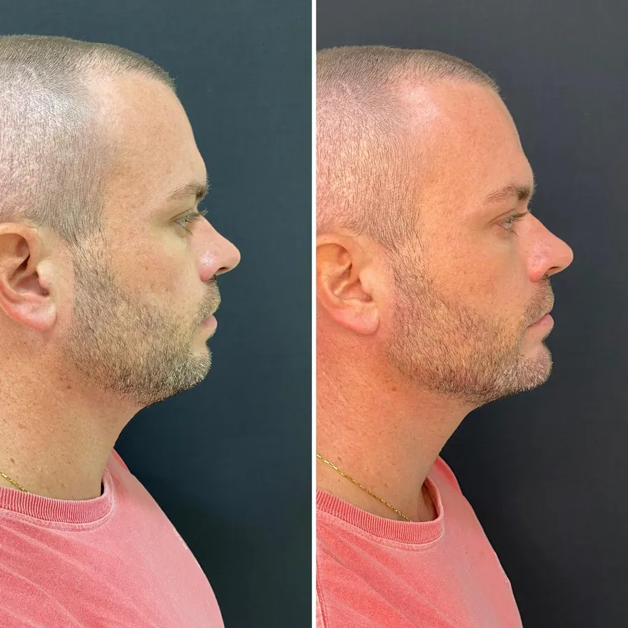 Antes e depois de paciente atendido na Jiovialle Estética Avançada