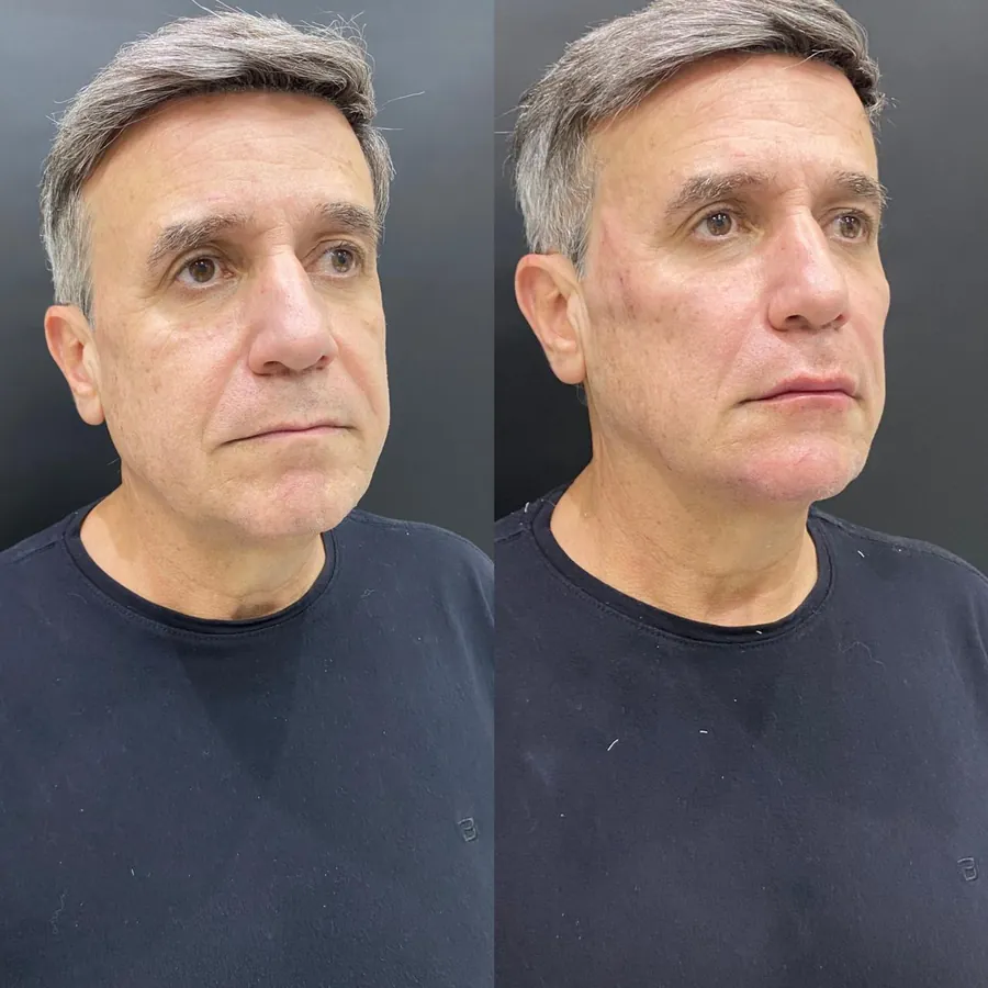 Antes e depois de paciente atendido na Jiovialle Estética Avançada
