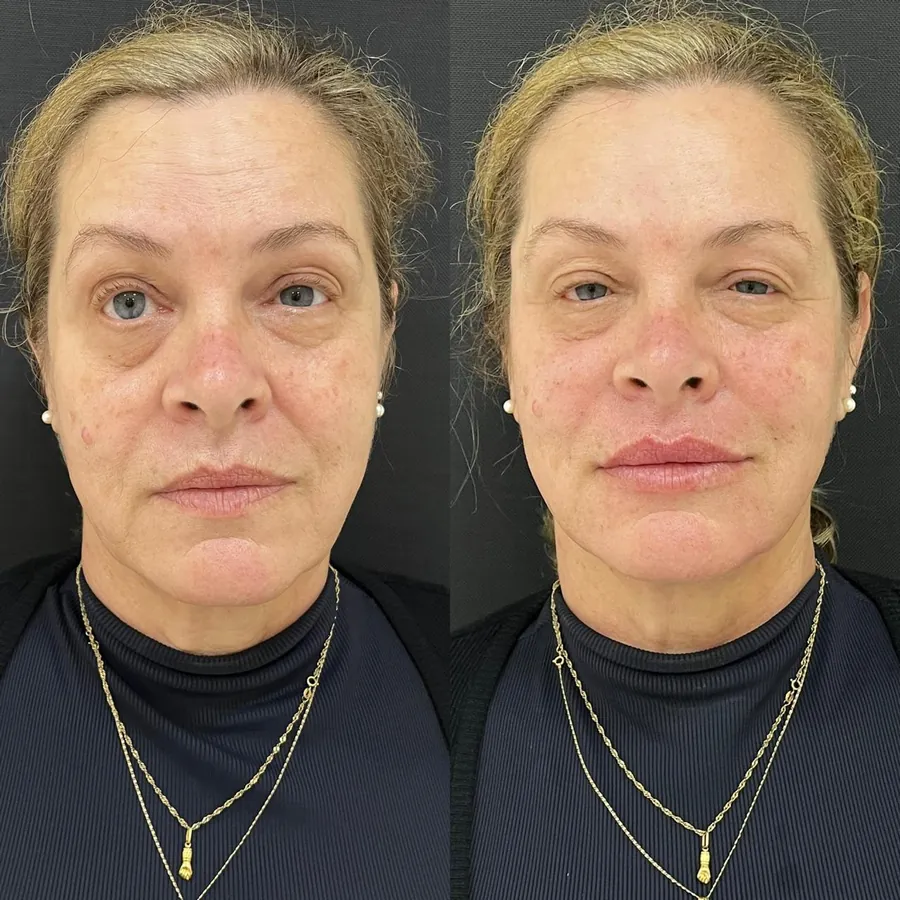 Antes e depois de paciente atendido na Jiovialle Estética Avançada