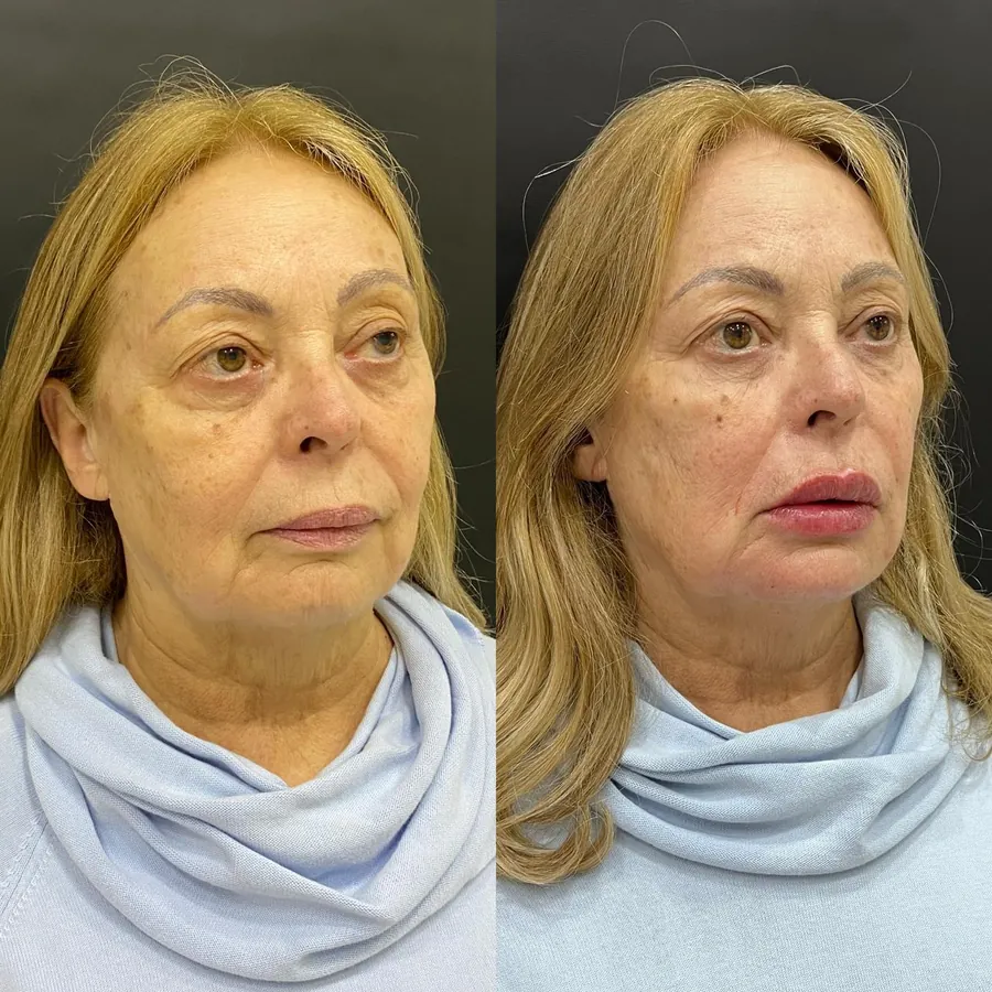 Antes e depois de paciente atendido na Jiovialle Estética Avançada