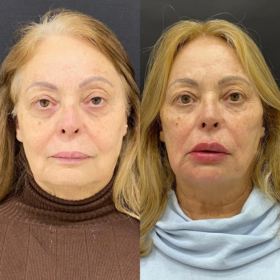 Antes e depois de paciente atendido na Jiovialle Estética Avançada