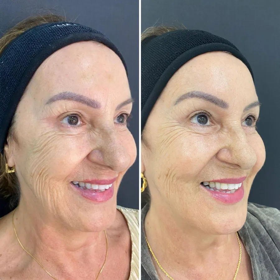 Antes e depois de paciente atendido na Jiovialle Estética Avançada