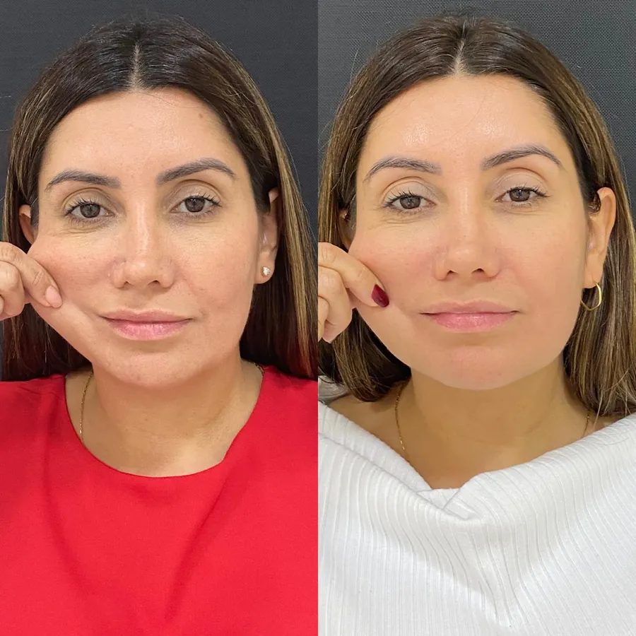 Antes e depois de paciente atendido na Jiovialle Estética Avançada