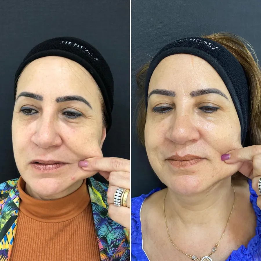 Antes e depois de paciente atendido na Jiovialle Estética Avançada