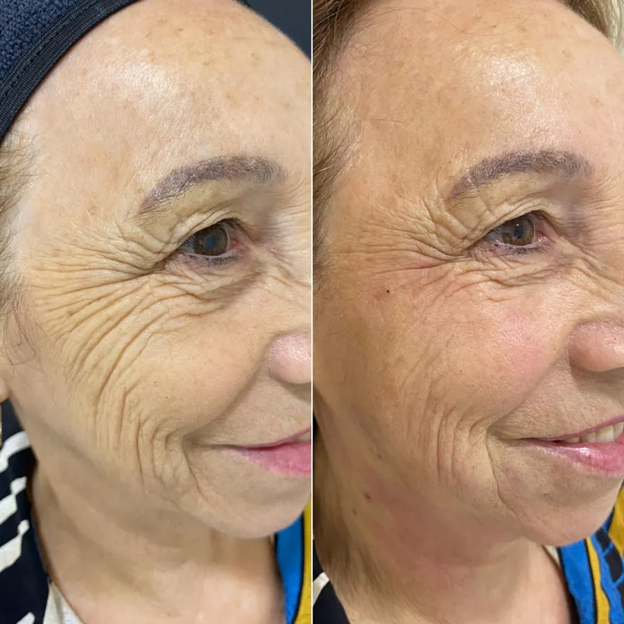 Antes e depois de paciente atendido na Jiovialle Estética Avançada